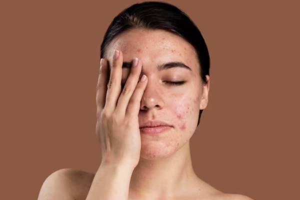 پوست جوشدار